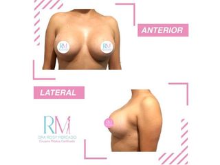 Antes y después de aumento de busto Dra. Rosy Mercado 