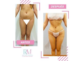 Antes y después de liposucción - Dra. Rosy Mercado 