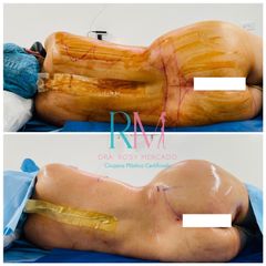 Antes y después de lipoescultura y aumento gluteo y cadera con grasa - Dra. Rosy Mercado
