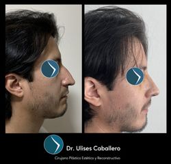 Rinoplastia - Dr. Ulises Caballero de la Peña