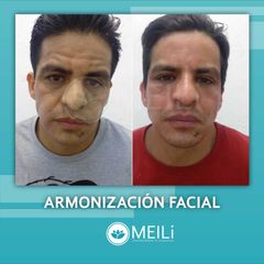 Armonización facial - MEILi - Rejuvenecimiento