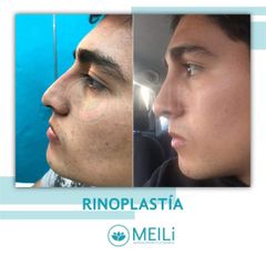 Rinoplastia - MEILi -  Rejuvenecimiento