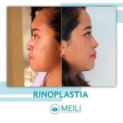 Rinoplastia - MEILi -  Rejuvenecimiento