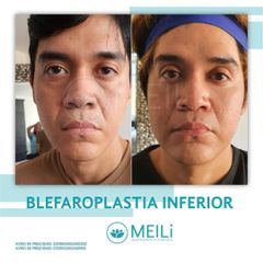 Blefaroplastia - MEILi -  Rejuvenecimiento