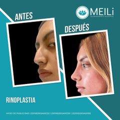 Rinoplastia - MEILi Rejuvenecimiento