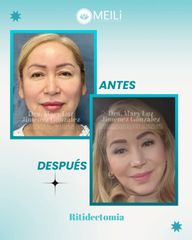 Ritidectomia - MEILi Rejuvenecimiento