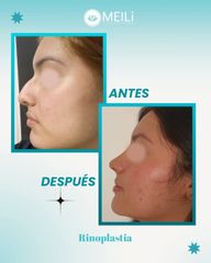 Rinoplastia - MEILi Rejuvenecimiento