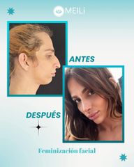 Feminización Facial - MEILi Rejuvenecimiento