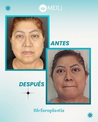 Blefaroplastia - MEILi Rejuvenecimiento