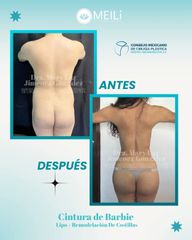 Lipo + Remodelación de Costillas - MEILi Rejuvenecimiento