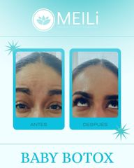 Toxina Botulínica - MEILi Rejuvenecimiento