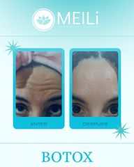 Toxina Botulínica - MEILi Rejuvenecimiento