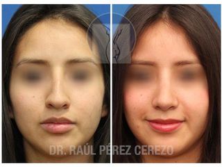 Antes y después de Rinoplastia estética y funcional.