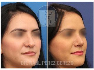 Antes y después de Rinoplastia estética y funcional.