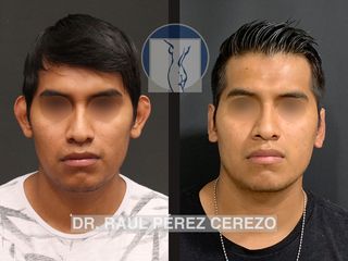 Antes y después de Otoplastia