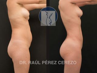 Antes y después de Lipoescultura 