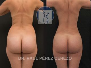 Antes y después de Lipoescultura 