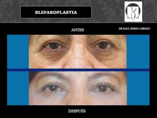 Antes y después de Blefaroplastia