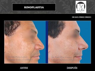 Antes y después de Rinoplastia