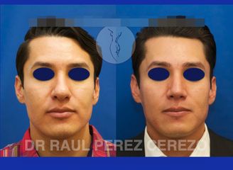 Antes y después de  Rinoplastia