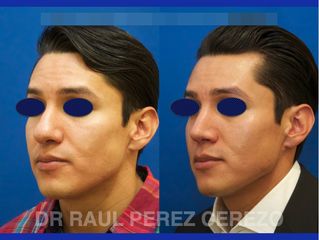 Antes y después de Rinoplastia