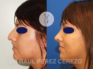 Antes y después de Rinoplastia