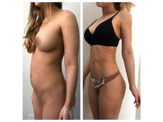 Antes y después de Liposucción