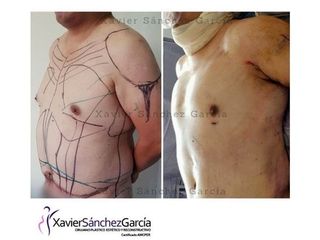 Antes y después de Lipoescultura