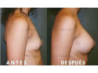 Antes y después de Aumento de busto