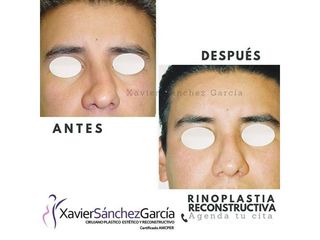 Antes y después de Rinoplastia reconstructiva