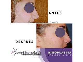 Antes y después de Rinoplastia