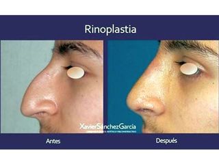 Antes y después de Rinoplastia