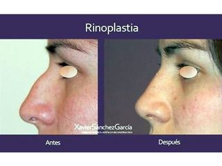 Antes y después de Rinoplastia