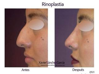 Antes y después de Rinoplastia