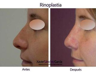 Antes y después de Rinoplastia