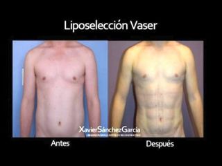 Antes y después de Lipoescultura