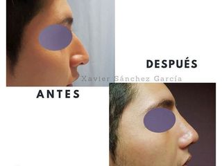 Antes y después de Rinoplastia