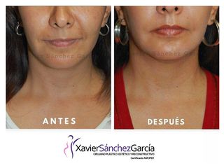 Antes y después de Aumento de labios