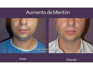 Antes y después de aumento de mentón