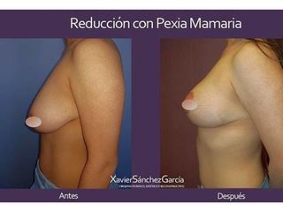 Antes y después de Mastopexia