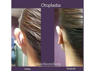 Antes y después de Otoplastia