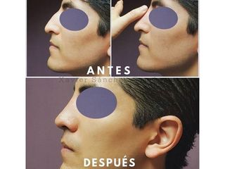 Antes y después de Rinoplastia