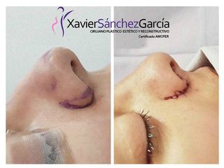 Antes y después de Rinoplastia