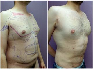 Antes y después de Abdominoplastia