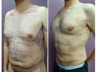 Antes y después de Abdominoplastia