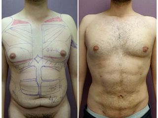 Antes y después de Abdominoplastia