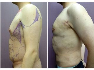 Antes y después de Abdominoplastia