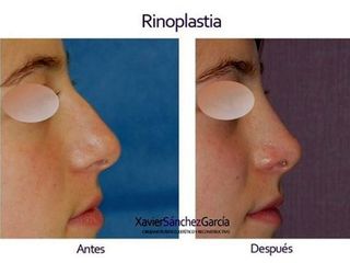 Antes y después de Rinoplastia