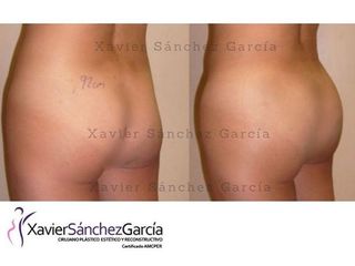 Antes y después de Gluteoplastia