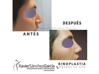 Antes y después de Rinoplastia